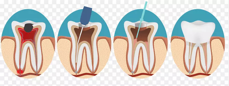 牙髓治疗根管牙髓牙科-牙科