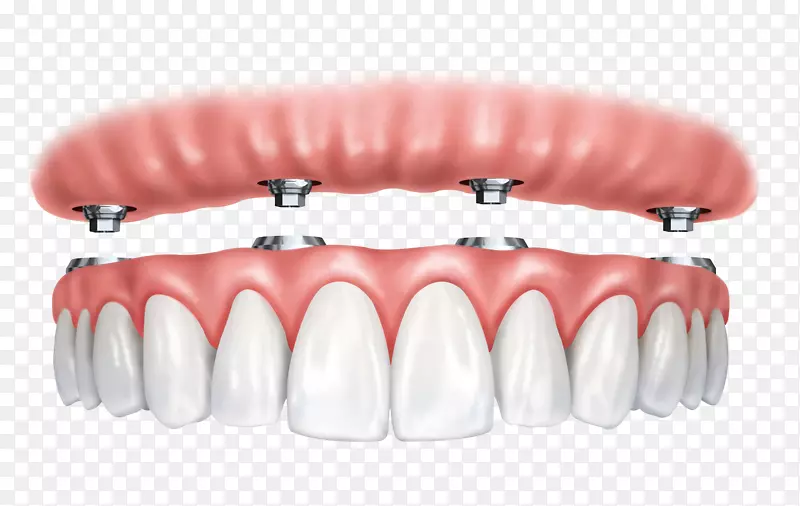 牙科种植体全对4牙科义齿.植入物