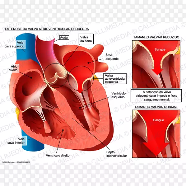 主动脉关闭不全主动脉狭窄室主动脉瓣-心脏