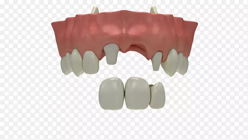 牙齿缺失，牙种植，牙科学，人类牙齿
