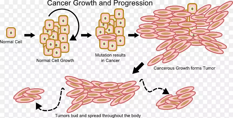 癌细胞生长瘤-肿瘤