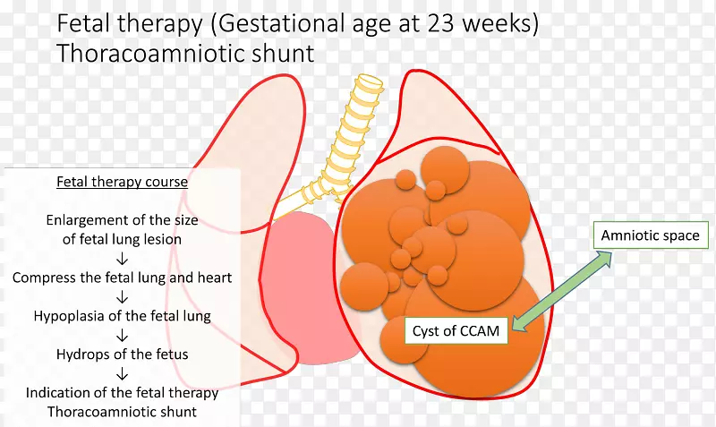 先天性肺气道畸形分流胎儿肺囊肿