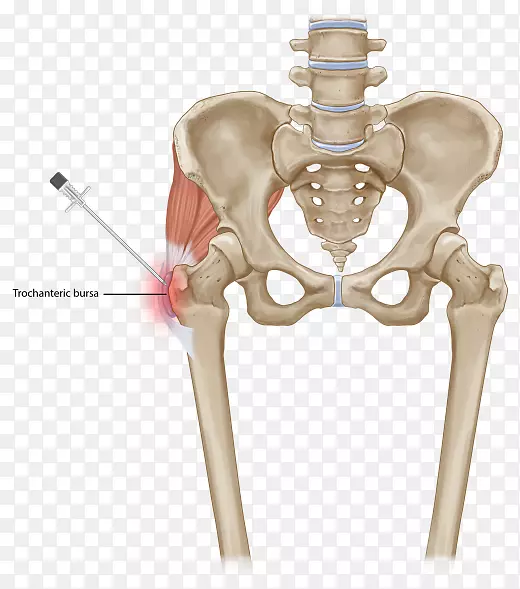 大转子疼痛综合征，下腰痛，脊柱肌肉骨盆