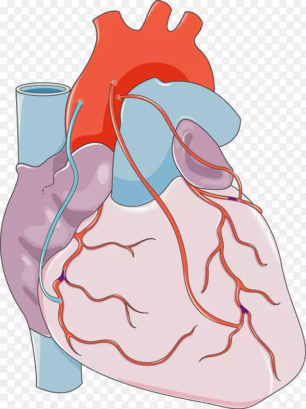 心脏冠状动脉旁路手术血管旁路冠状动脉-心脏