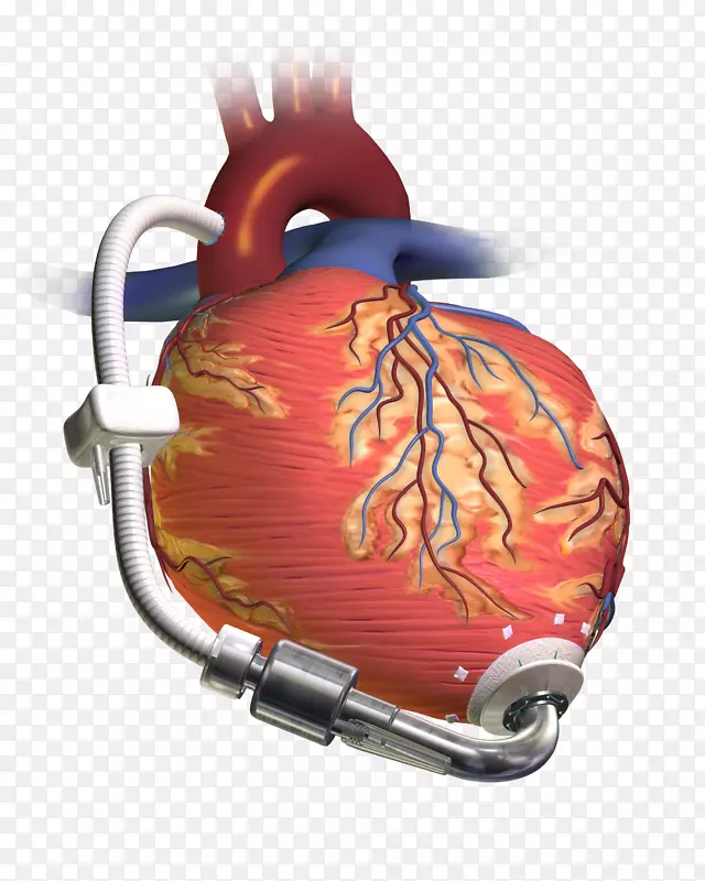 心室辅助装置心脏移植人工心室-左心室
