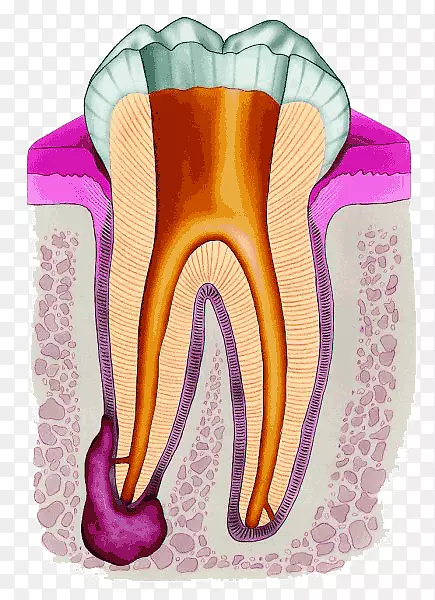 牙髓治疗根管牙髓牙科学.牙冠