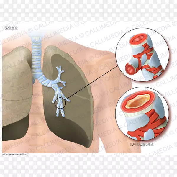 急性支气管炎哮喘肺毛细支气管炎支气管-支气管