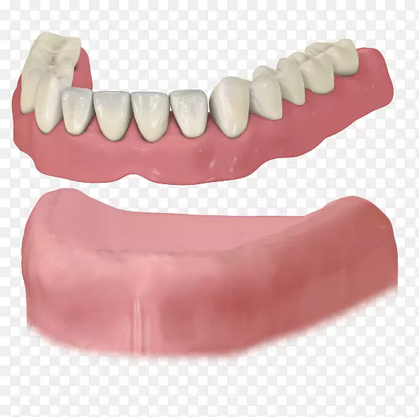 牙科种植义齿可摘局部义齿牙科.桥