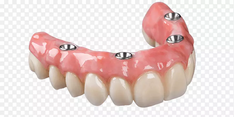 牙科种植义齿，可摘局部义齿，牙科义齿.桥
