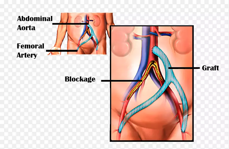 血管旁路冠状动脉旁路手术股动脉主动脉周围动脉疾病