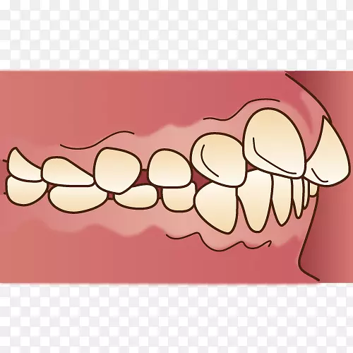 歯科错牙合牙套牙列牙医-牙科