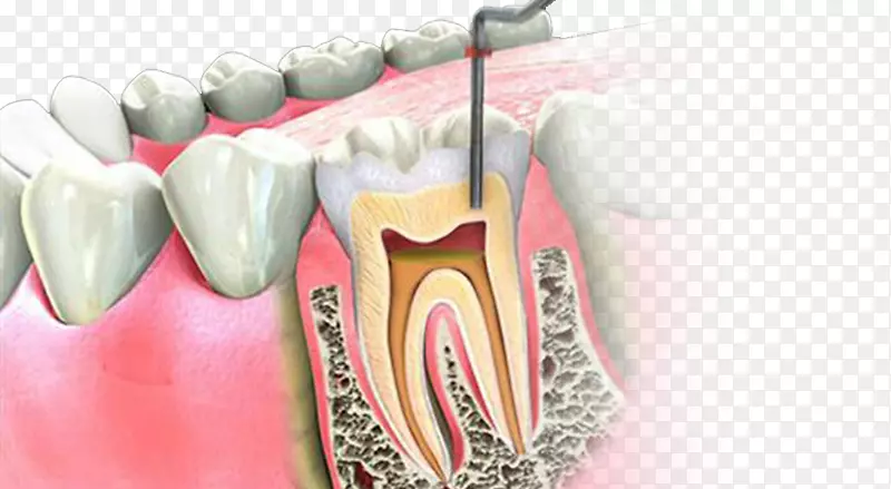 牙髓治疗根管牙髓学牙科学根管