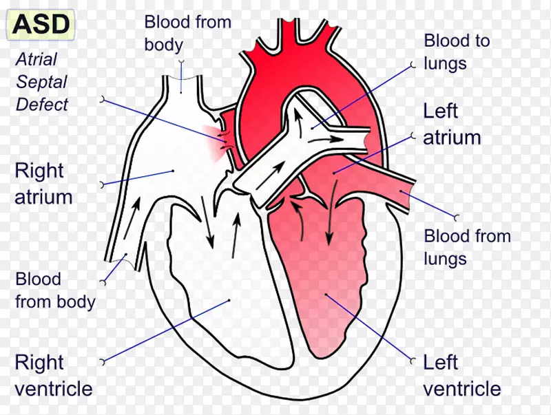 房间隔缺损室间隔缺损房间隔-心脏