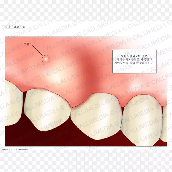牙脓肿，牙周脓肿，牙龈，牙齿-人呼吸系统