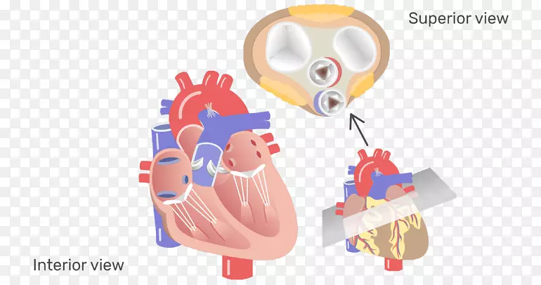 主动脉瓣心脏瓣膜病主动脉-心脏瓣膜