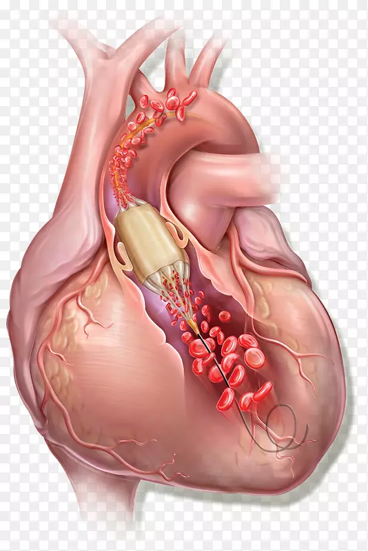 球囊导管球囊瓣膜成形术r。巴德心