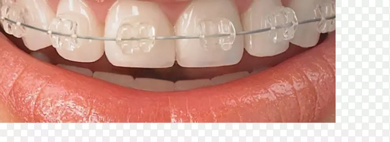 戴蒙系统韦伯正畸牙床牙科-牙医牙齿美白