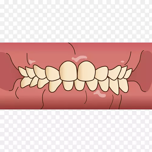 牙齿牙医歯科Prognathism牙科保健员-儿童牙科