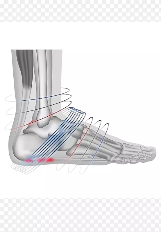 足底筋膜炎体外冲击波治疗足底筋膜足