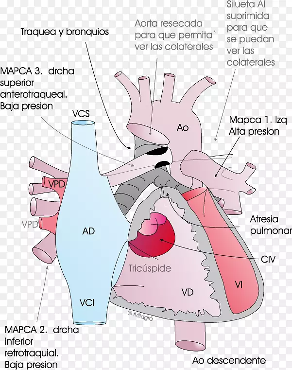 肺动脉闭锁室间隔缺损肺动脉主动脉