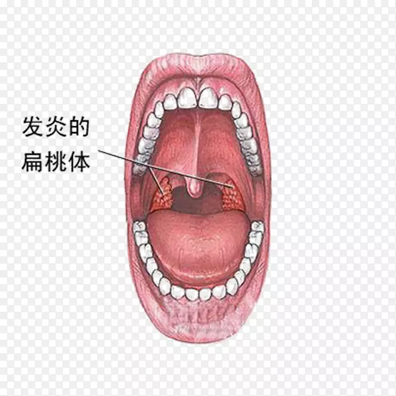 扁桃体炎、炎症症状、疾病-癌症病变