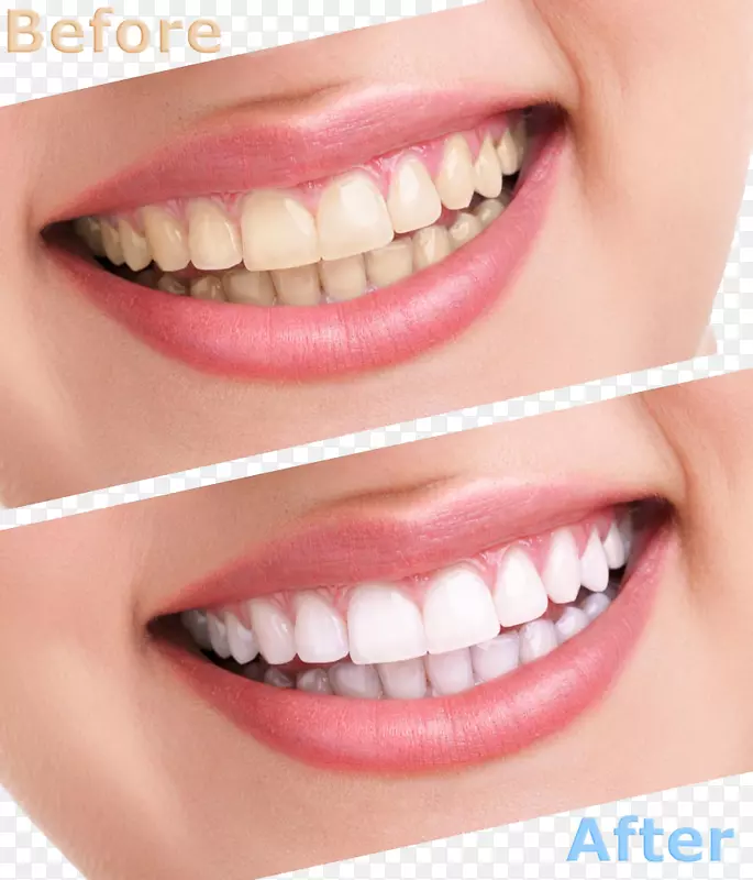 牙齿美白人牙齿美容牙科.清洁牙齿的比较