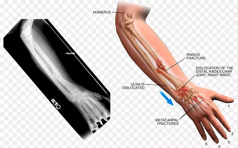 拇指手臂扭伤x射线手臂扭伤