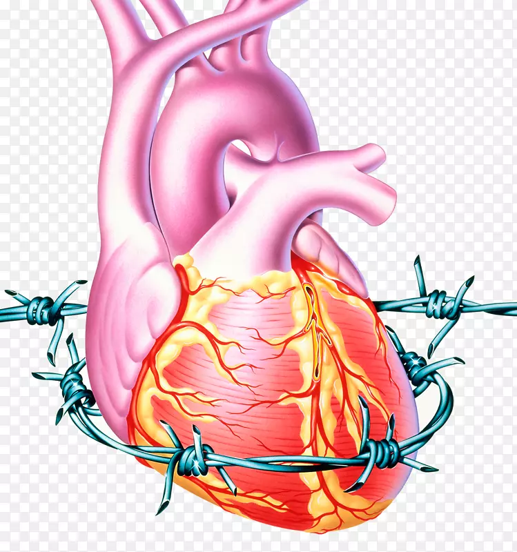 缺血性心脏病-胆固醇型冠心病心绞痛