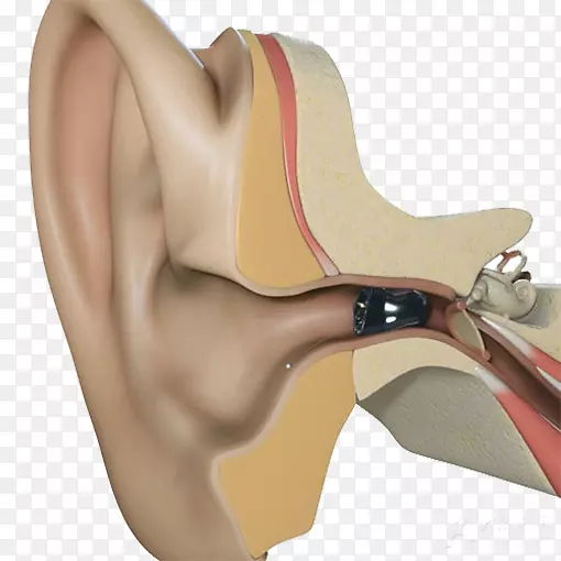 助听器Starkey实验室耳道-耳小助听器