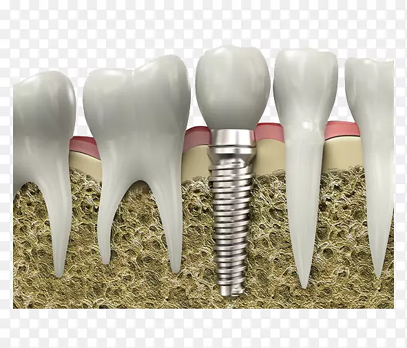 牙科种植牙外科种植牙图片材料