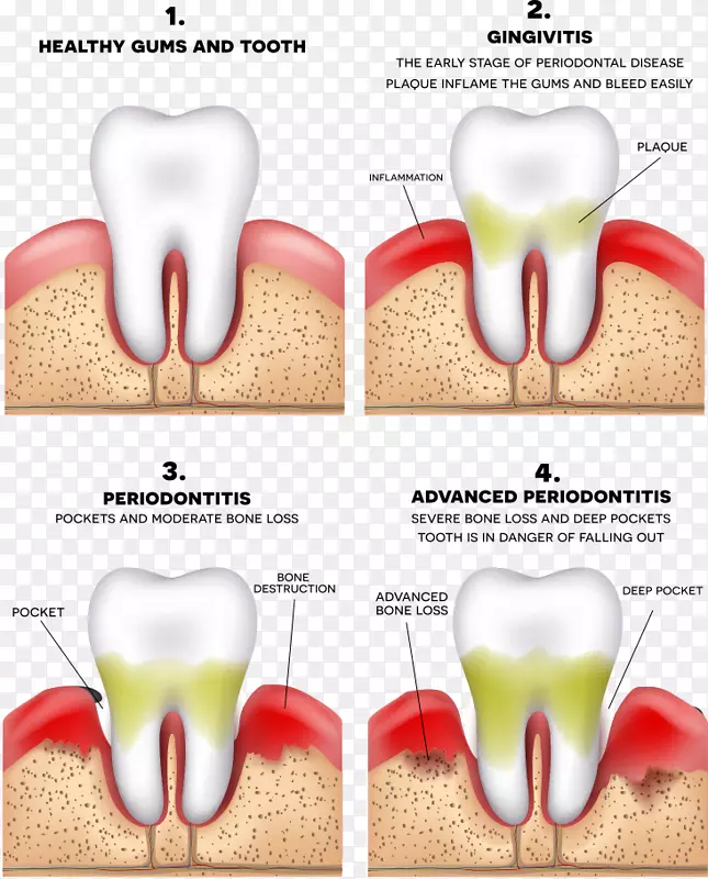 牙周炎、牙龈、牙周病、牙科学.载体牙和坏牙