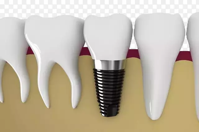 牙种植体牙科贴面牙修复.白色牙齿材料