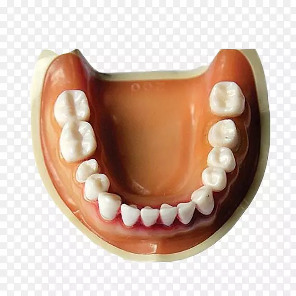牙齿义齿，口腔原型，无冠义齿，拉拔材料