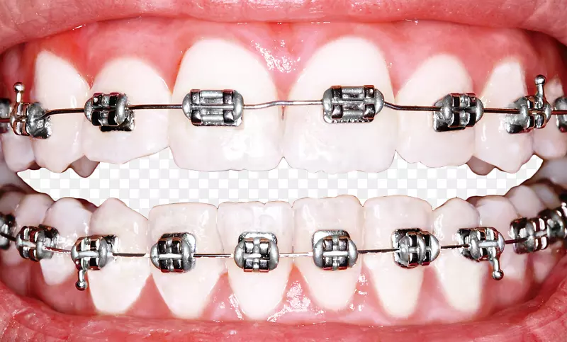 牙科牙套正畸牙齿美白完美牙列