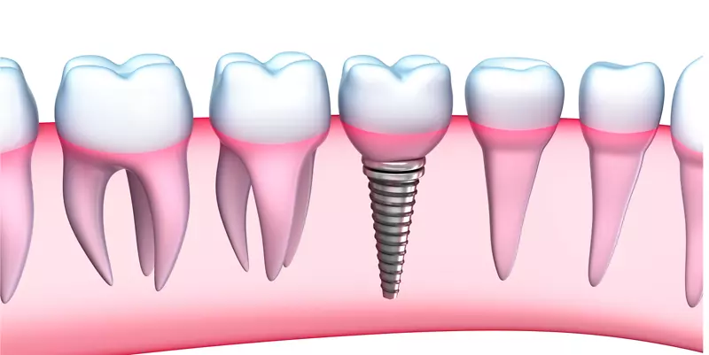 牙种植体牙科学人牙齿义齿