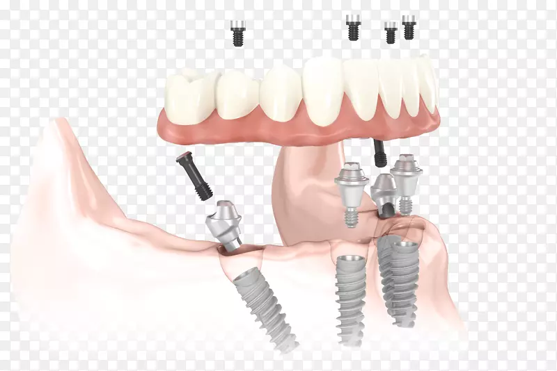 牙科种植体全对4牙科义齿.牙科