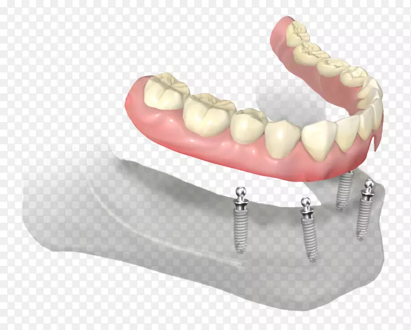 义齿、牙科种植体、基牙、假牙-牙齿