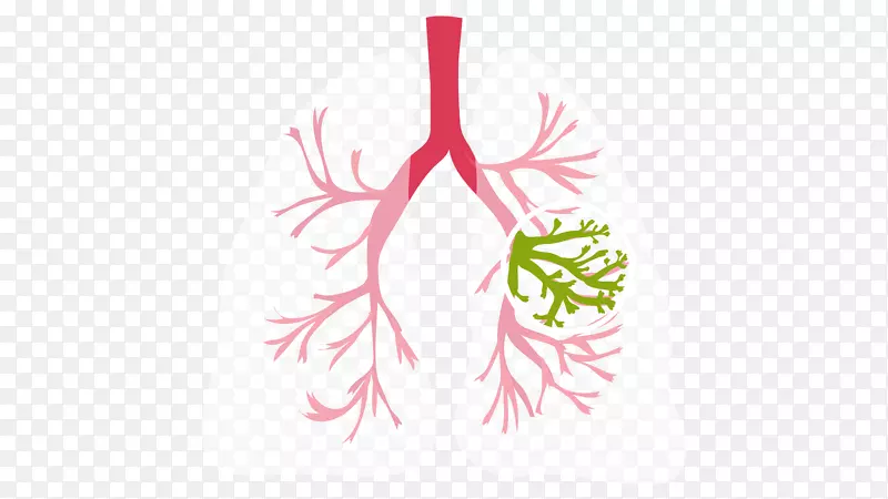 囊性纤维化肺医学诊断症状孤立性肺结节-肺