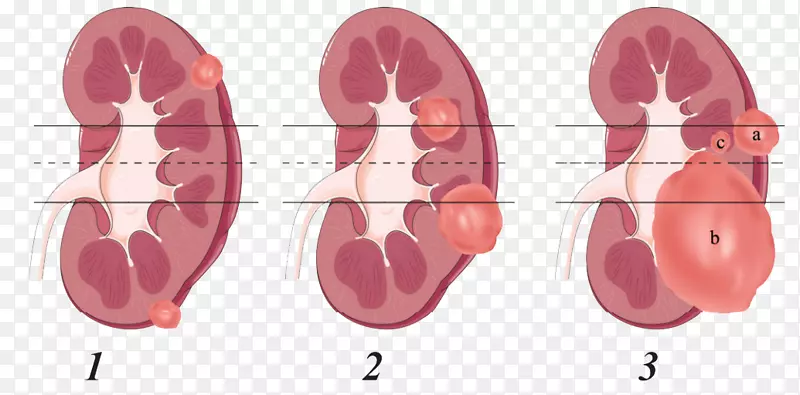 肾肿瘤肾切除肾细胞癌解剖-肾