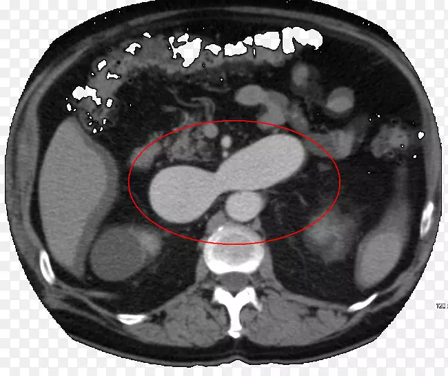 动静脉畸形CT动脉瘤血管畸形肾