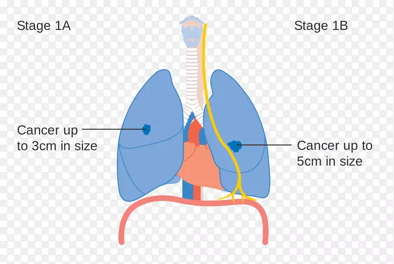 肺癌分期-肺