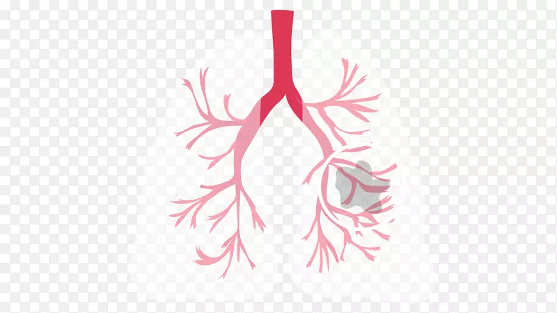 非小细胞肺癌囊性纤维化-肺