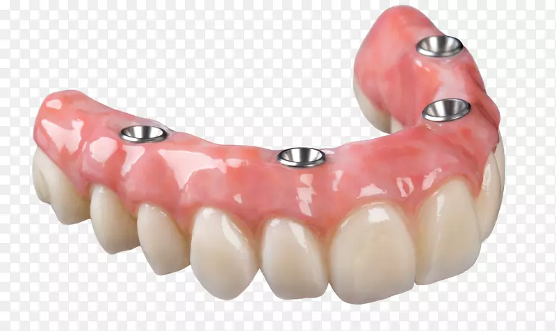 全4可摘局部义齿桥牙种植义齿