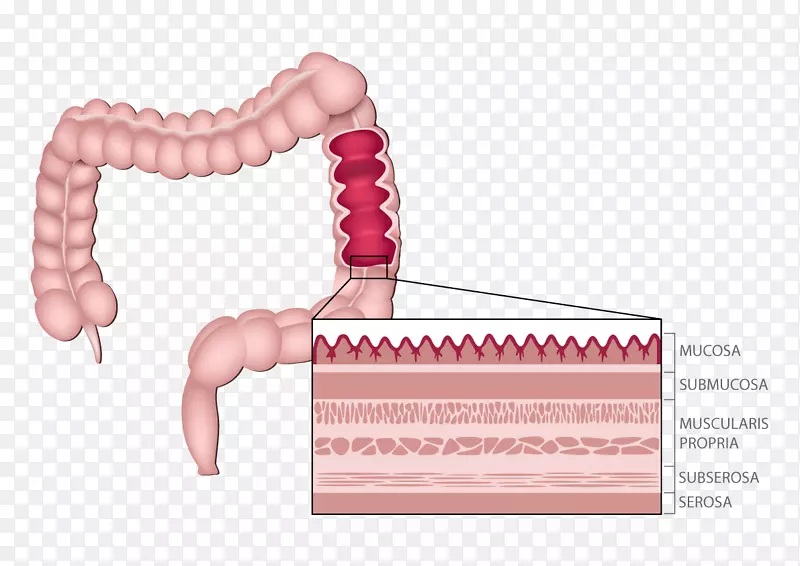 遗传性非息肉病结直肠癌大肠手术解剖
