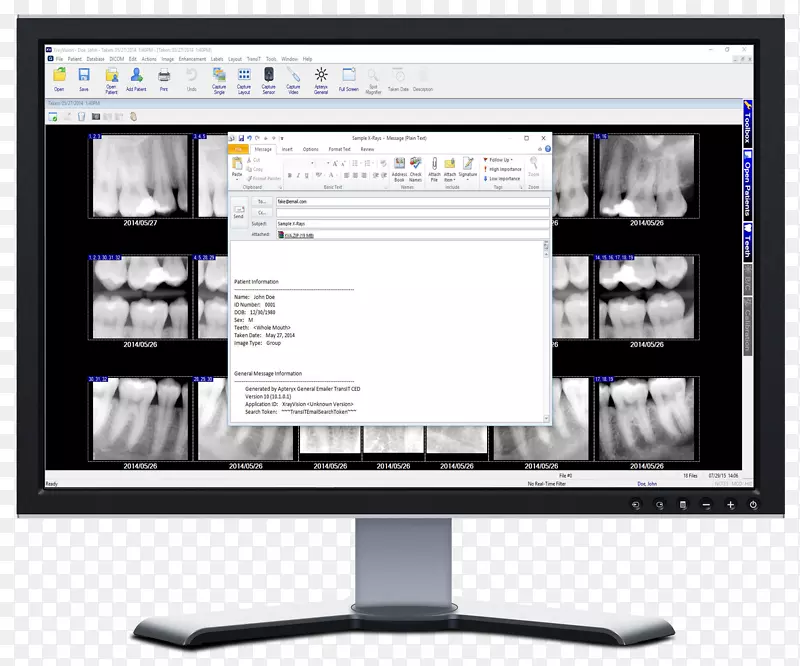x射线视觉电脑显示器电脑软件显示装置牙科摄影-发送电子邮件按钮
