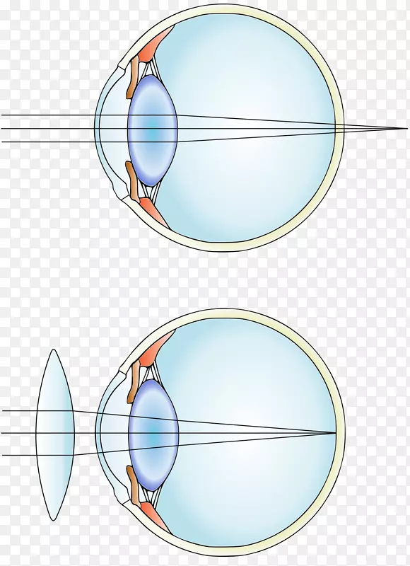 近视、远视、矫正性晶状体散光屈光手术.视力