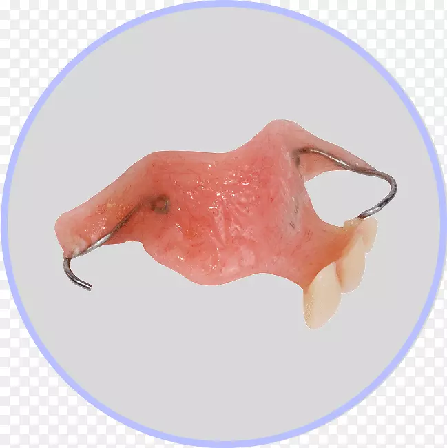 杜兰特义齿可摘局部义齿
