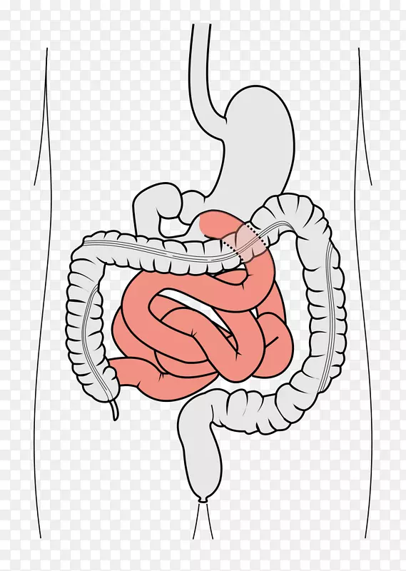 胃肠道、大肠、小肠、十二指肠漏肠综合征-肝