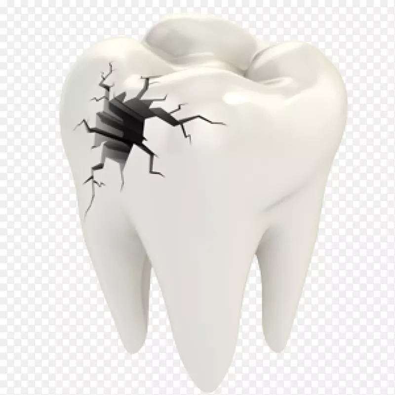 牙裂综合征牙科修复人牙