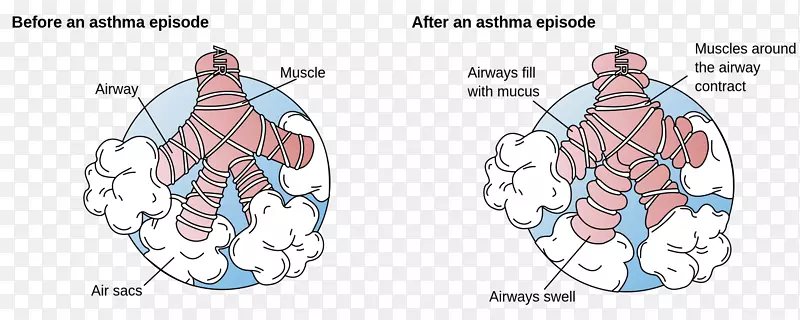 哮喘支气管呼吸困难支气管痉挛病-肺
